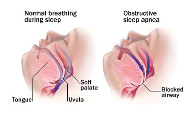 Is Sleep Apnea impacting your life?